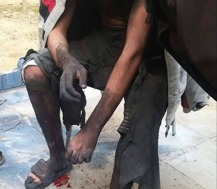 مصدومیت یک نوجوان در انفجار مواد محترقه در تهران مصدومیت یک نوجوان در انفجار مواد محترقه در تهران