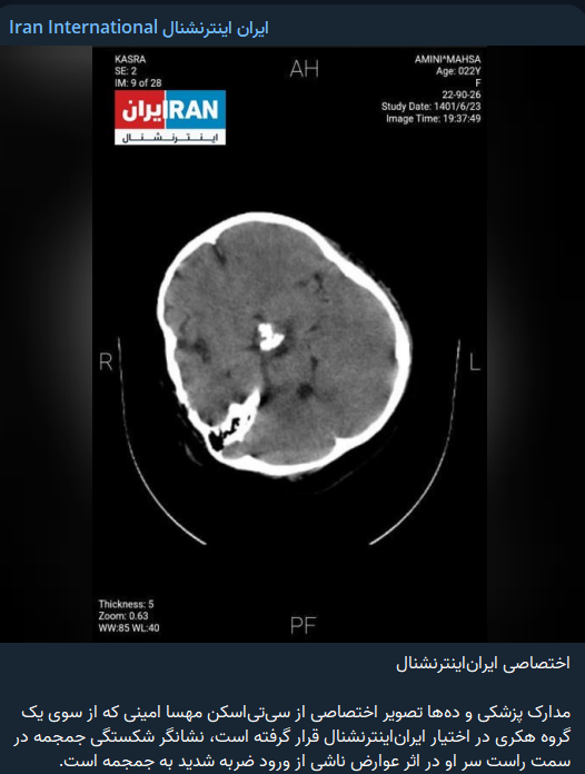 اعتراف ضد انقلاب به دروغ بزرگ پس از یک‌سال؛ آیا به جمجمه مهسا امینی ضربه وارد شده بود؟