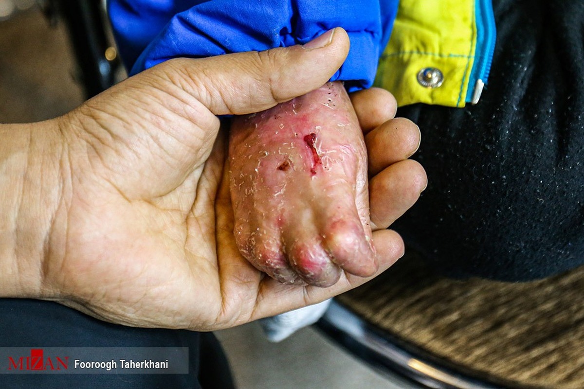 تحریم پانسمان بیماران پروانه‌ای؛ واقعیت‌هایی که در رسانه‌های اصلی غرب سانسور می‌شود