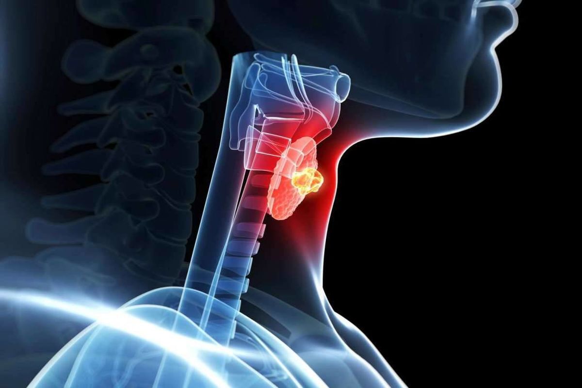 بیانیه انجمن جراحان عمومی ایران به مناسبت روز جهانی تیروئید