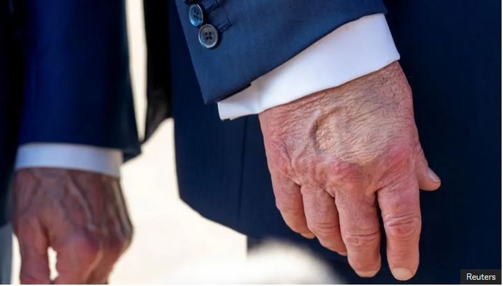 درباره بیماری دونالد ترامپ چه می‌دانیم؟