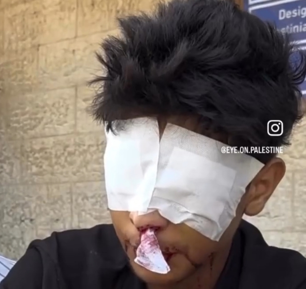 نوجوان فلسطینی در راه غذا، چشمانش را از دست داد