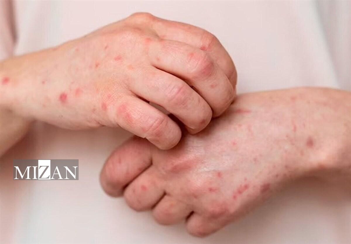 آبله‌مرغان در بزرگسالان؛ بیماری شدیدتر و عوارض خطرناک‌تر از کودکان