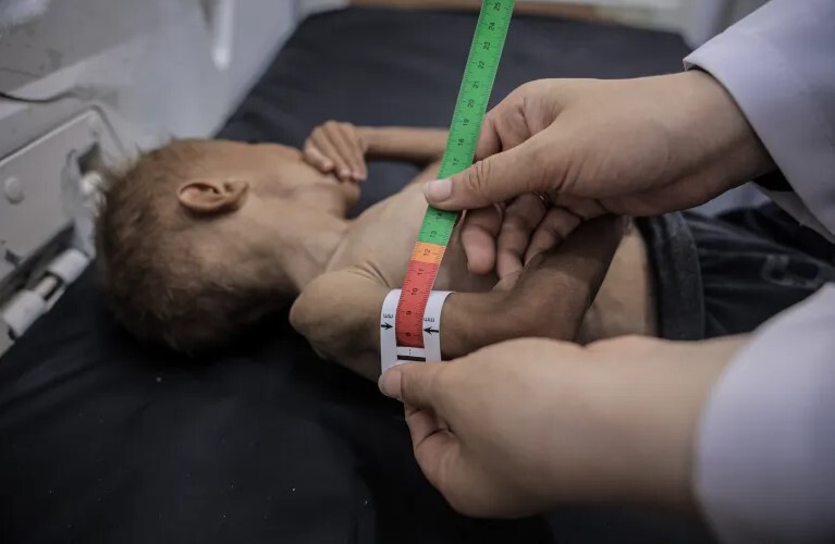 الگوی گرسنگی غرب در غزه؛ محرومیت، حمله به امدادرسان‌هاو سوءتغذیه اصل‌های کلیدی پیشبرد استراتژی نسل کشی رژیم صهیونیستی