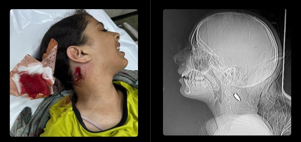 افشای ابعاد جدید جنایت صهیونیست‌ها در غزه؛ شلیک عمدی به سر و سینه کودکان فلسطینی