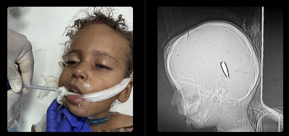 افشای ابعاد جدید جنایت صهیونیست‌ها در غزه؛ شلیک عمدی به سر و سینه کودکان فلسطینی