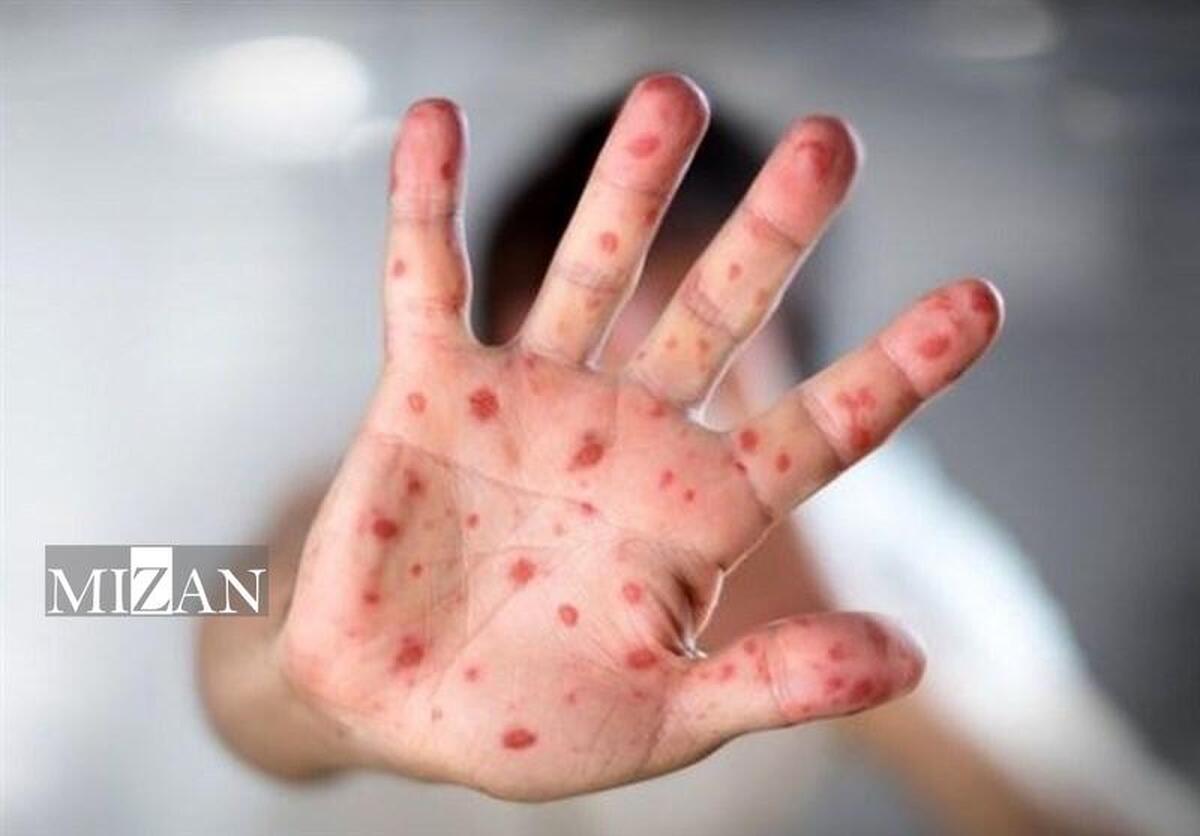 بروز مواردی از سرخک در بابل به دلیل مقاومت در تزریق واکسن