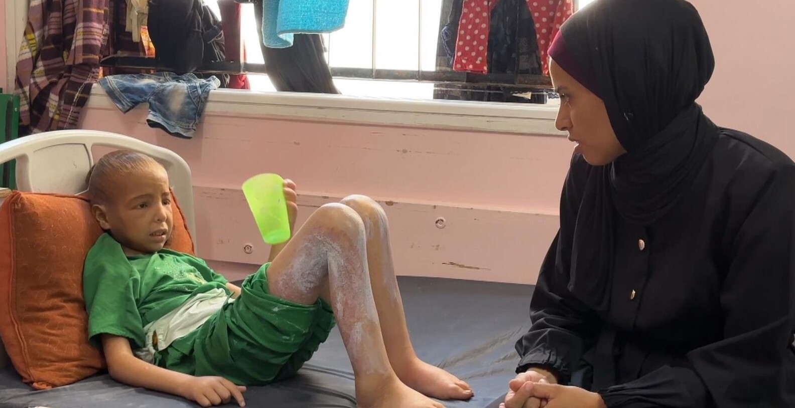 کودک مبتلا به سوءتغذیه در غزه