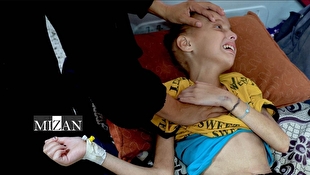 ابتلای ۵۵ هزار کودک غزه به سوءتغذیه حاد