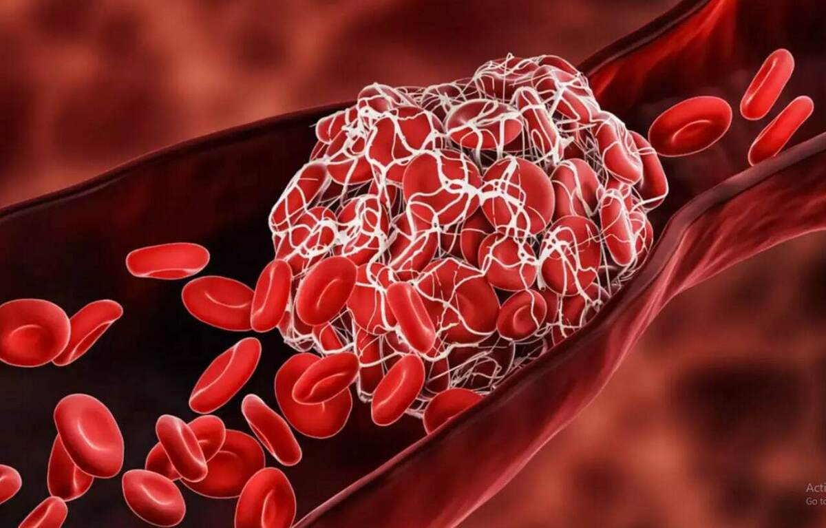 علل ایجاد لخته خون در عروق از زبان فلوشیپ جراحی عروق