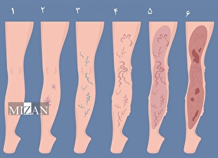 با چند عادت ساده از ابتلا به واریس پیشگیری کنیم