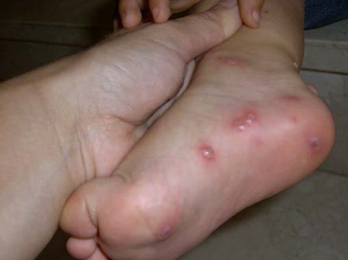 همه چیز در مورد آبله مرغان در کودکان