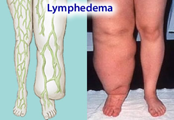 تورم مچ نشانه چه بیماری خطرناکی است؟ تورم مچ نشانه چه بیماری خطرناکی است؟