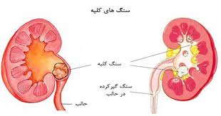 سنگ کلیه