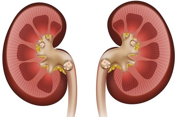چگونه بدون دارو به جنگ سنگ کلیه برویم؟