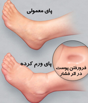 چرا پاهایمان باد می کند؟