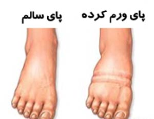 چرا پاهایمان باد می کند؟