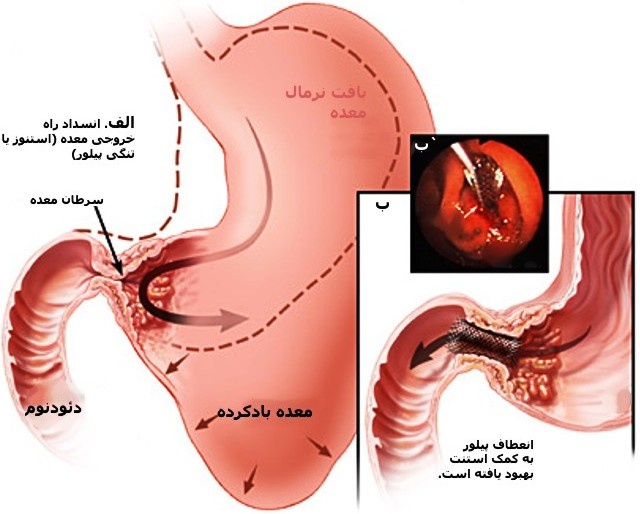 چرا سرطان معده می گیریم؟
