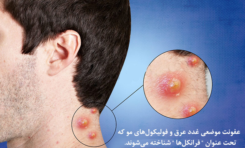 راه حلی برای رهایی از دمل چرکی