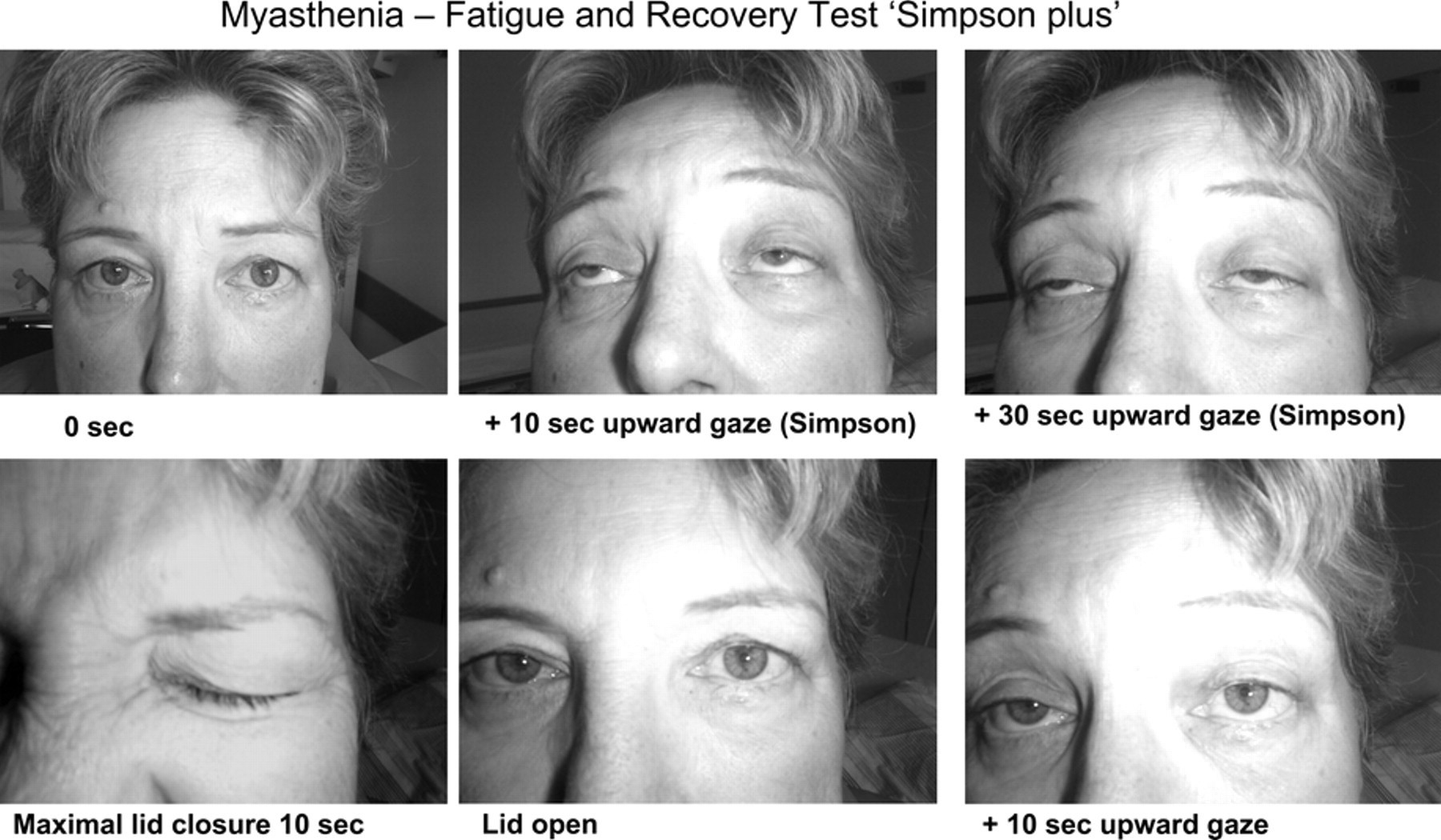 علائم میاستنی گراویس چیست و چه درمانی دارد؟