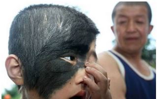 عجیب‌ترین نشانه‌های مادرزادی در جهان +عکس