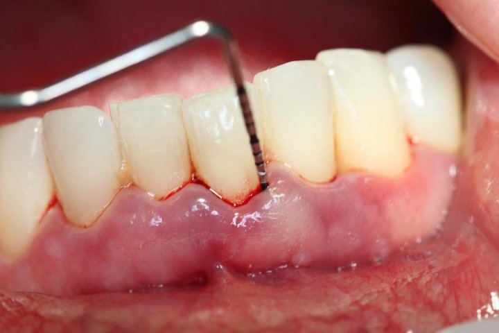 دلایل خونریزی لثه کدامند؟ دلایل خونریزی لثه کدامند؟