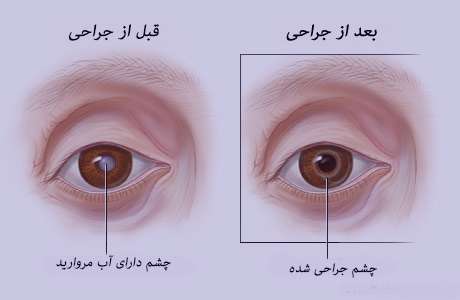 خطر آب مروارید با مصرف استاتین