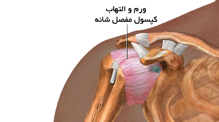 شانه یخ زده چیست؟ + علائم و راه درمان
