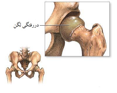 درمان در رفتگی لگن نوزاد در منزل درمان در رفتگی لگن نوزاد در منزل