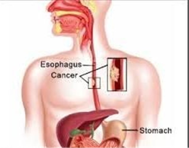 احتمال ابتلا به سرطان مری با نوشیدن چای داغ احتمال ابتلا به سرطان مری با نوشیدن چای داغ