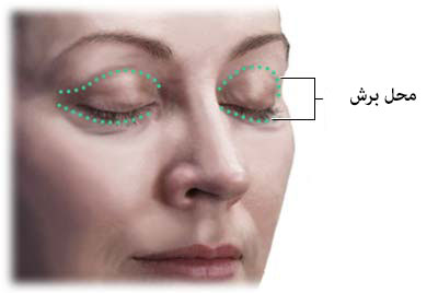 خانم ها رکورددار این عمل جراحی هستند خانم ها رکورددار این عمل جراحی هستند