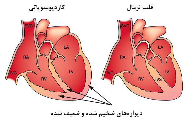 کاردیومیوپاتی چیست و چه علایمی دارد کاردیومیوپاتی چیست و چه علایمی دارد