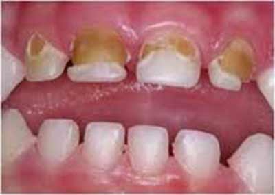 ترفندی برای جلوگیری از پوسیدگی دندان در کودکان ترفندی برای جلوگیری از پوسیدگی دندان در کودکان