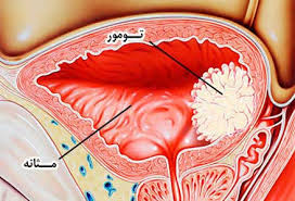 هم آنچه باید در مورد سرطان مثانه بدانید هم آنچه باید در مورد سرطان مثانه بدانید