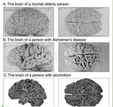 الکل و آلزایمر چه تاثیری روی مغز انسان دارد؟+تصاویر
