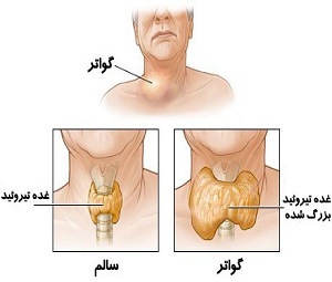 گواتر چیست؟ + درمان خانگی گواتر چیست؟ + درمان خانگی