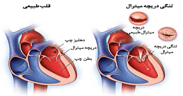 افتادگی دریچه میترال چیست؟ + علائم و درمان افتادگی دریچه میترال چیست؟ + علائم و درمان