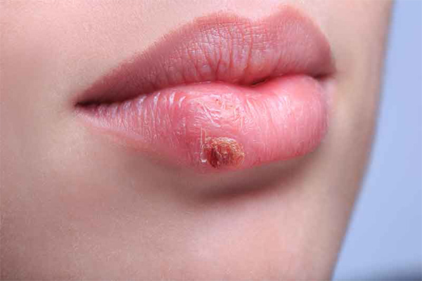 تبخال و راه‌های خلاصی از آن