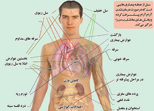 تکنولوژی به کمک درمان سل آمد تکنولوژی به کمک درمان سل آمد