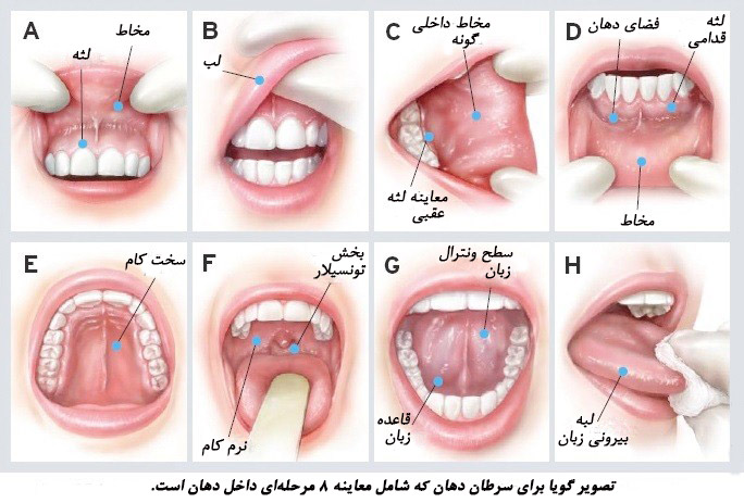 عامل ابتلا به سرطان دهان شناسایی شد عامل ابتلا به سرطان دهان شناسایی شد