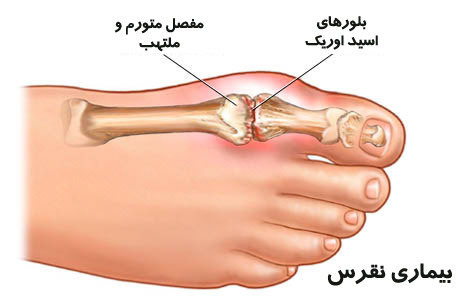 نقرس را با این خوراکی درمان کنید نقرس را با این خوراکی درمان کنید