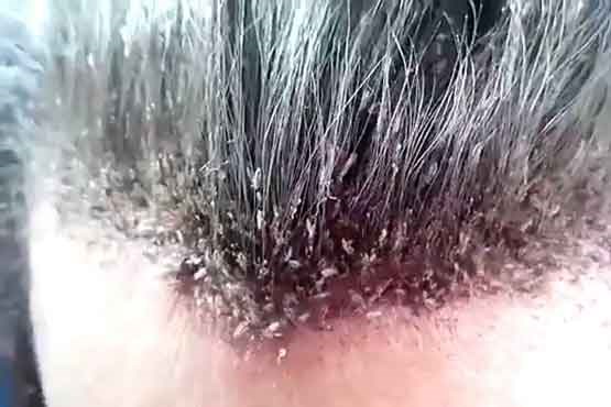 چگونه با شپش مقابله کنیم؟ چگونه با شپش مقابله کنیم؟