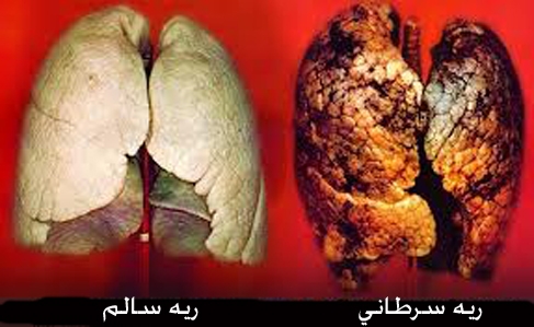 چرا سیگار سبب سرطان ریه می شود؟ چرا سیگار سبب سرطان ریه می شود؟