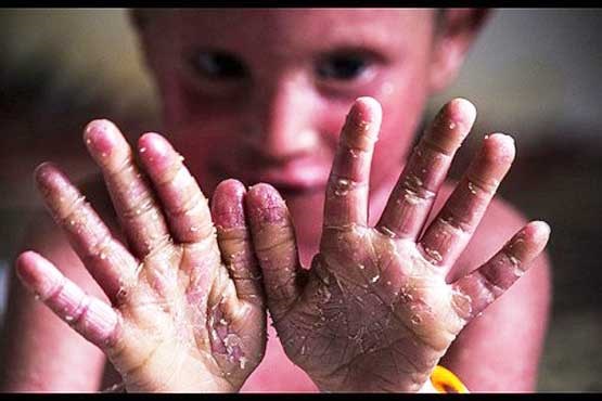 علت ابتلا به EB چیست؟ علت ابتلا به EB چیست؟