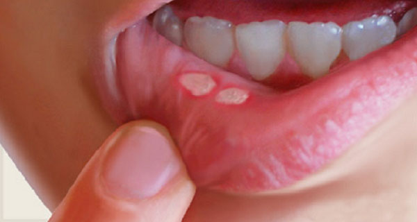 نسخه طب سنتی برای درمان آفت دهان چیست؟