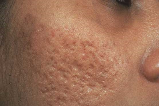 علل ایجاد جوش سرسیاه روی صورت چیست؟ علل ایجاد جوش سرسیاه روی صورت چیست؟