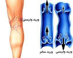 رگ بنفش روی پا نشانه واریس نیست رگ بنفش روی پا نشانه واریس نیست