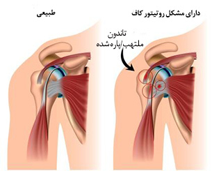 دلایل اصلی شانه درد چیست؟ دلایل اصلی شانه درد چیست؟