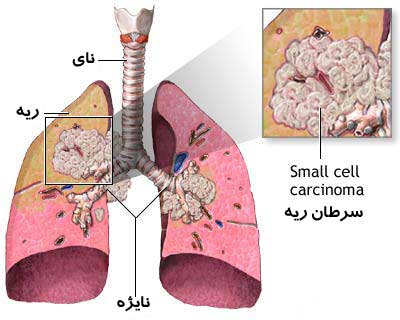 6 ترفند برای فرار از ابتلا به سرطان