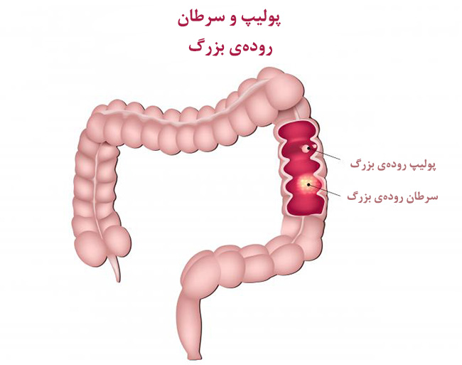 غذاهایی که شما را در مقابل سرطان روده بیمه می کنند